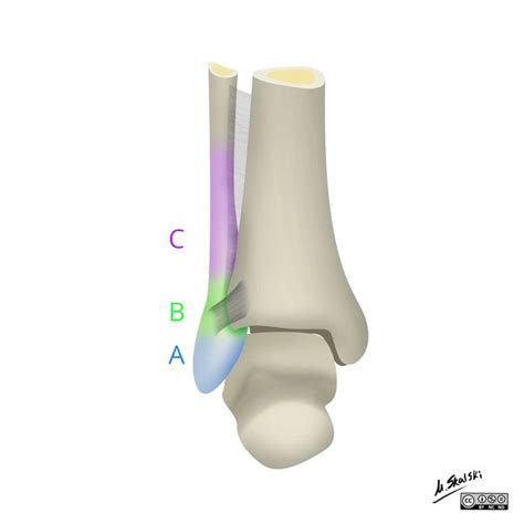 Weber ankle fracture classification | Radiology Reference Article | Radiopaedia.org | Ankle ...