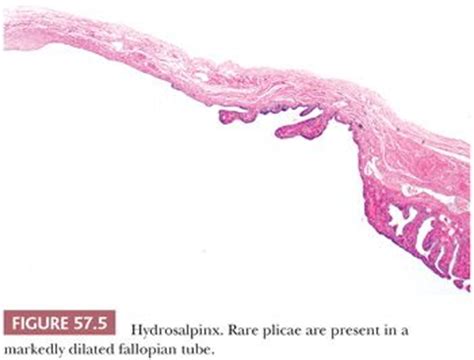 Fallopian Tube and Broad Ligament | Basicmedical Key