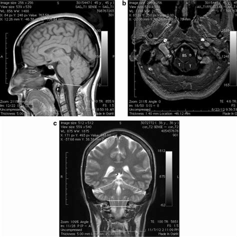 a Mid-sagittal T1 MRI image showing the cerebellar tonsil positioned... | Download Scientific ...