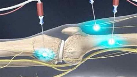 Genicular Nerve Radiofrequency Ablation for Knee Pain