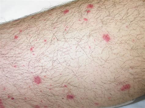 Petechiae - Pictures, Causes, Diagnosis, Treatment and Cure