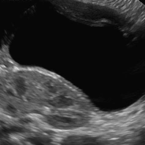 . Ectopic kidney located in the pelvis behind the bladder. | Diagnostic medical sonography ...