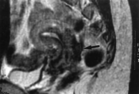 Deep endometriosis of the pouch of Douglas in a 30 year old woman.... | Download Scientific Diagram