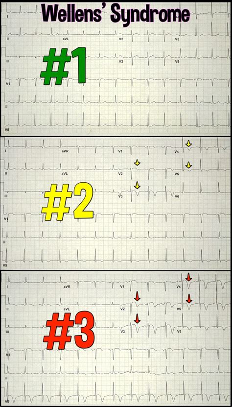 Wellens' Syndrome, What is the Wellens' Sign - Doctablet®