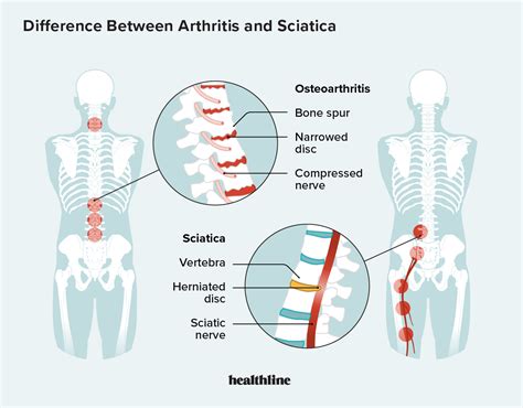 Spinal Osteoarthritis