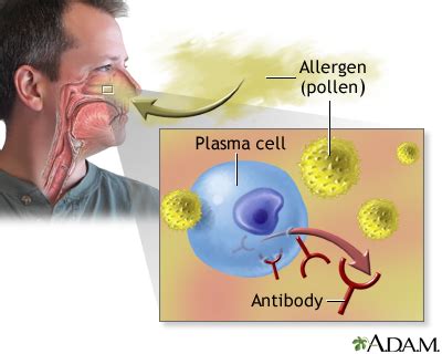 Allergic rhinitis: MedlinePlus Medical Encyclopedia