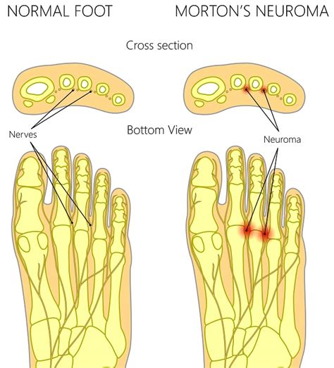 Capsulitis of the Second Toe Treatment [Taping, Orthotics & Best Shoes!]