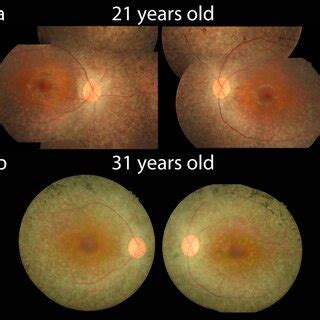 Color fundus of both eyes. a At presentation, fundus shows mild... | Download Scientific Diagram