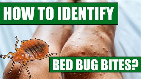 How To Identify Bed Bug Bites - Can Doctors or Exterminators Identify Bed Bug Bites? - YouTube