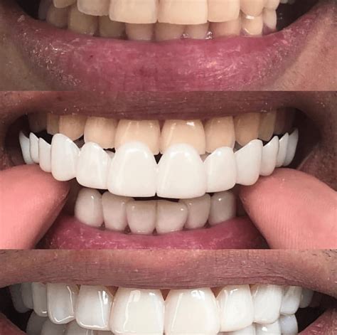 What are clip on veneers? | News | Dentagama