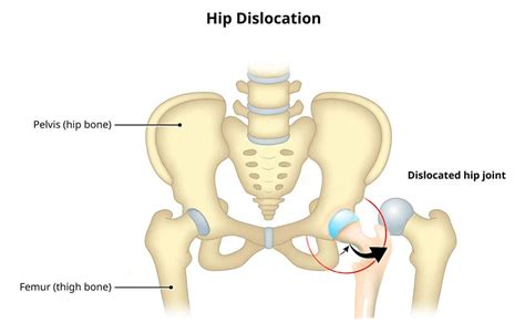 Hip Dislocation: Causes, Procedures, and Rehabilitation - PushAsRx Athletic Training Centers El ...