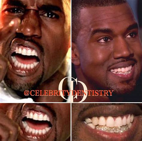 Kanye West Gold Teeth