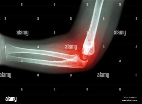 Rheumatoid arthritis , Gouty arthritis ( film x-ray child 's elbow with arthritis at elbow ...