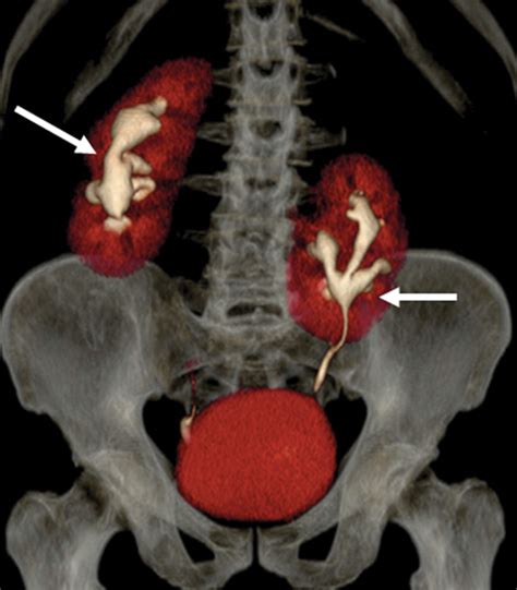 Congenital Anomalies Of The Upper Urinary Tract A Comprehensive Review | Free Download Nude ...