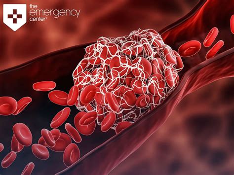 When Blood Clots Become An Emergency | The Emergency Center