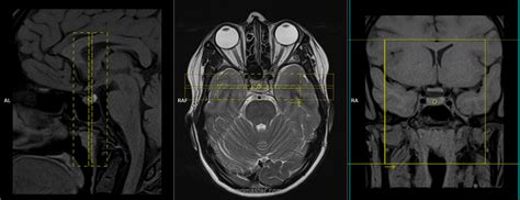 Pituitary MRI Protocols, Planing and Indications | Pituitary Dynamic