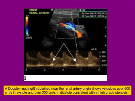 Renal doppler ultrasound