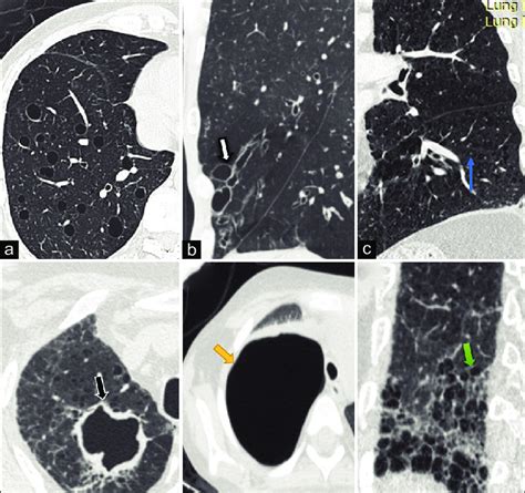 Lung cyst mimics. (a) Cyst: Multiple air-containing lesions having ...