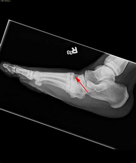 What Is A Lisfranc Fracture Dislocation | The Best Porn Website