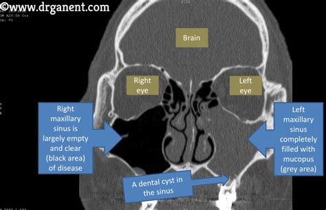 Sinusitis from a tooth infection (WARNING – GRAPHIC MEDICAL IMAGES ...