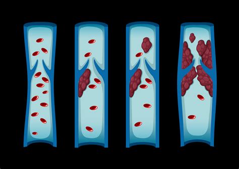 Different stages of blood clot in human 297245 Vector Art at Vecteezy