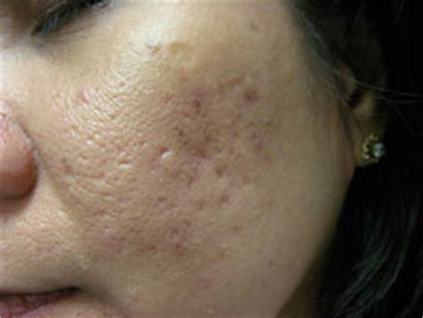 Acne Scarring Toronto | Best Acne Treatment