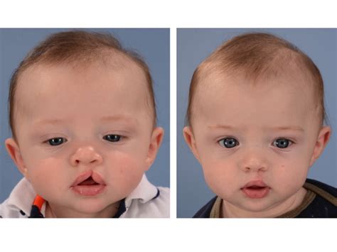 Cleft Lip Before and After Photos — Dallas Pediatric Plastic Surgeon, Craniofacial Surgeon ...