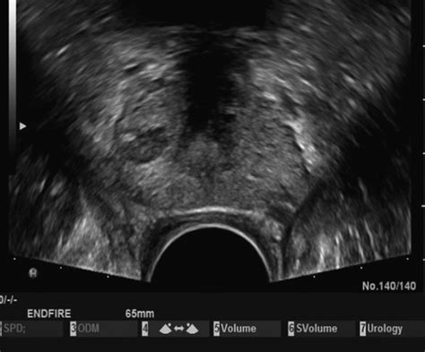 Prostate Anatomy Ultrasound