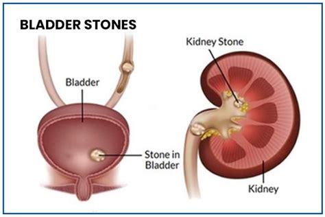 Bladder Stones: Causes, Symptoms, Treatment & Diagnosis