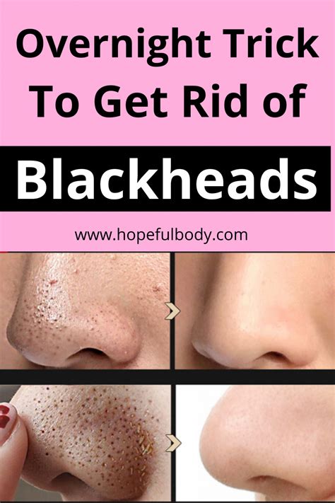 10 Simple And Easy Home Remedies to Get Rid of Blackheads in 2020 | Get rid of blackheads ...