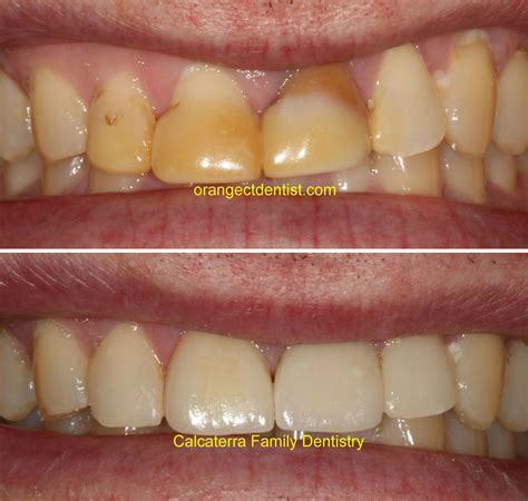 All Ceramic Crowns | Calcaterra Family Dentistry | Cosmetic Dentists