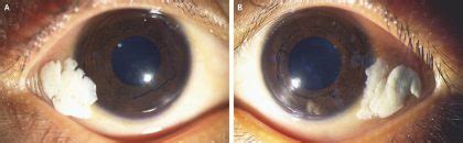 PGI Doctors report a classical case of Bitot’s Spots