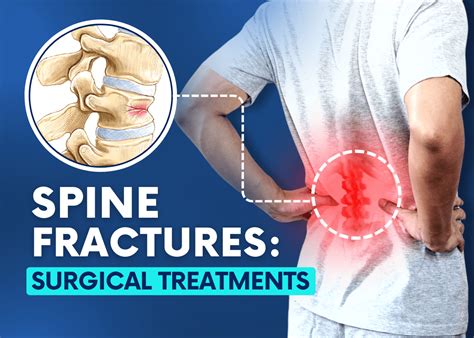 Spine Fractures and Spine Fracture Surgery - Turan&Turan