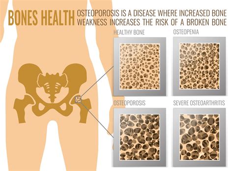 Osteoporosis Bones Poster - Beverly Hills Cardiovascular