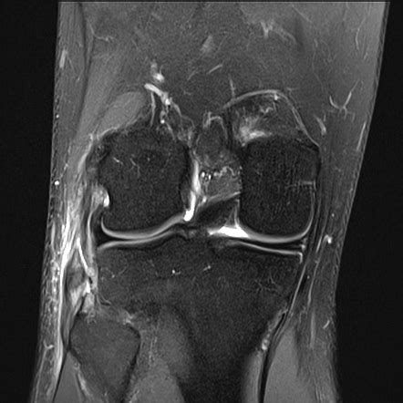 Fibular Collateral Ligament Mri