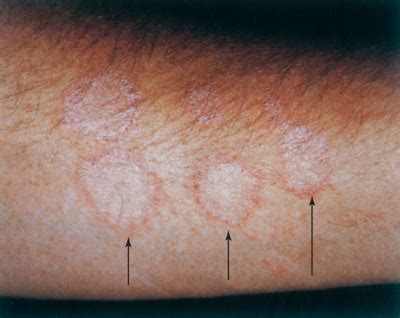 Dermatophytes, Sporothrix, and Other Superficial and Subcutaneous Fungi | Sherris Medical ...