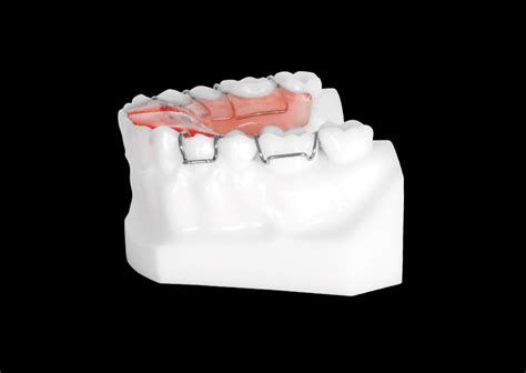 Schwartz Appliance with Adam Clasps (Lower) - Universal Orthodontic Lab