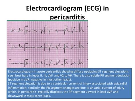 Acute Pericarditis ECG Changes