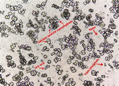 Premium Photo | Microscopic Urinalysis showing calcium oxalate monohydrate, uric acid and triple ...