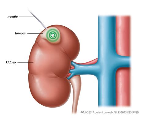 Ablation therapy - Patient Information