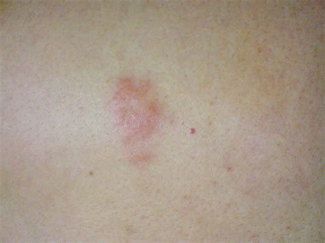 File:Herpes zoster back.jpg - Wikimedia Commons