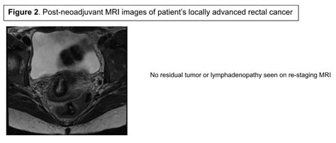 Robotic Low Anterior Resection with Diverting Loop Ileostomy for Locally Advanced Rectal Cancer ...