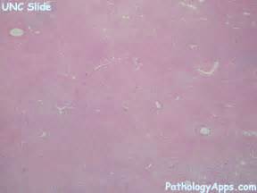 cellular angiofibroma pathology