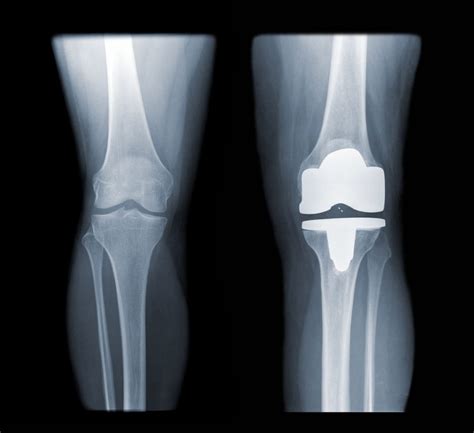 Ortho Xray Knee replacement | MSO Physiotherapy