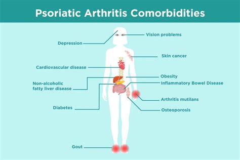 stages of psoriatic arthritis - Captions Prince