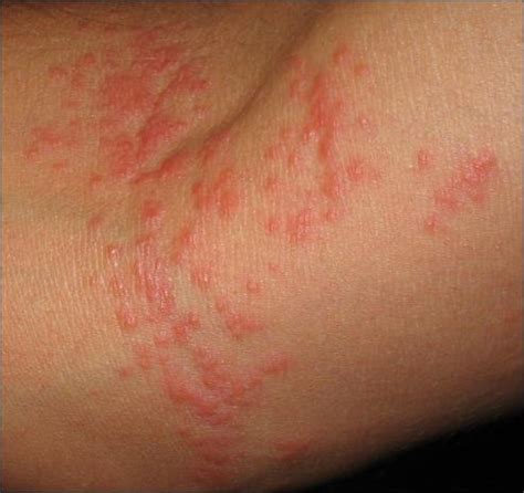 Rash on Body That Itches | Dorothee Padraig South West Skin Health Care