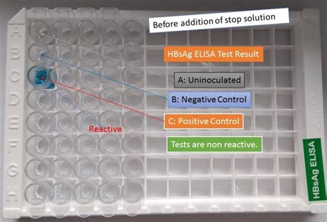 HBsAg ELISA: Introduction, Principle, Procedure, Result Interpretation