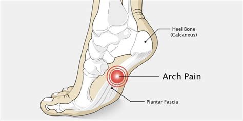 Prevent and Alleviate Foot Arch Pain With These Moves - Ayurveda and Yoga