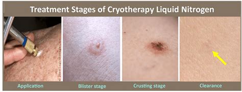 Cryosurgery Liquid Nitrogen in Plano, TX | Skin MD & Beyond