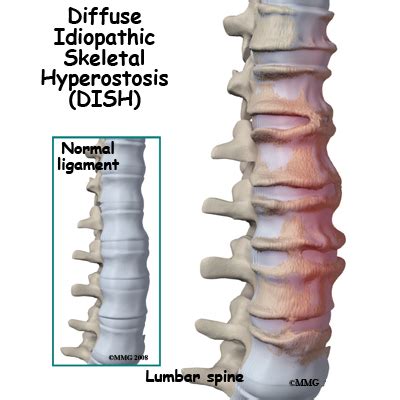 Diffuse Idiopathic Skeletal Hyperostosis - eOrthopod.com